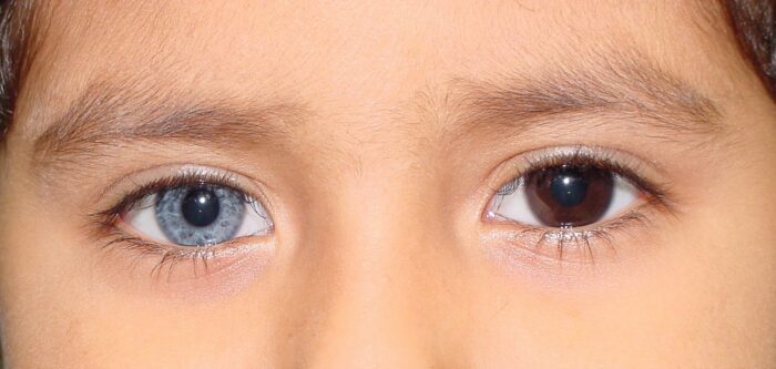completeheterochromia