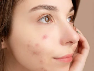 Are acne patches any good