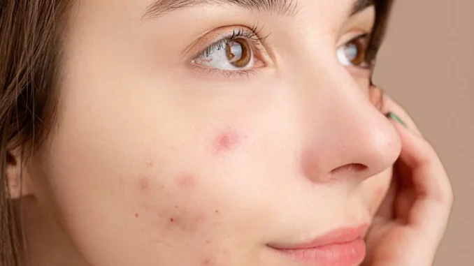 Are acne patches any good