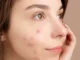 Are acne patches any good