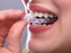 Clear Aligner Searches Surge 66% as More UK Adults Explore Discreet Orthodontic Options